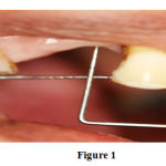 Figure 1: Pre-operative view of maxillary right premolar region (14, 15) shows 7 mm alveolar ridge defect.