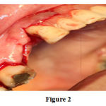 Figure 2: After giving crestal incision palatally in the region of the missing tooth 14,15 and continued by giving sulcular incision to the adjacent teeth