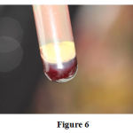 Figure 6: Freshly prepared platelet rich plasma . Defect on the mesial aspect of 21 grafted with DMBM /coagulated PRP mixture