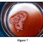 Figure 7: Demineralized bone matrix combined with coagulated PRP prior to insertion into defect.