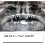 Fig1.OPG after implant placement