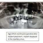 Fig2.OPG 6 month post operative after implant placement , implant displaced in the maxillary sinus.
