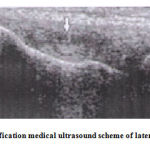 Figure 5: calcification medical ultrasound scheme of lateral Epicondylitis