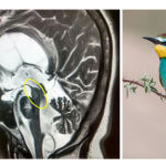 Figure 2: Bee-eater bird pareidolia that mimic progressive supranuclear palsy.