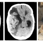 Figure 3: Pareidolia from Snake ready to bite. Serpentine hemorrhagic vascular malformation (AVM) with significant enhancement in axial brain CT scan with and without contrast