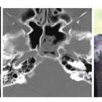 Figure 4. Koala pareidolia that mimic sinusitis in the sphenoid sinus and thickness of its mucosa.