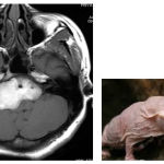 Figure 6: 28 years old female with right cerebello pontine angle epidermoid cyst that mimic mole rat. T1W axial MR images show a well-defined high intensity mass encasing basilar artery extending to internal auditory canal on right side.