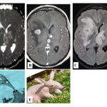 Figure 7: Anteater animal picture that mimic brain tumor metastasis in A) T2W, B) FLAIR, C) T1W, D) Anteater TV cartoon, and E) real picture of Anteater. Enhanced mass in T1W shows the multi edema in the brain.