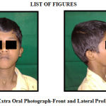 Figure 1: Extra Oral Photograph-Front and Lateral Profile View