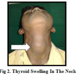 Figure 2: Thyroid Swelling In The Neck