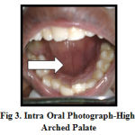 Figure 3: Intra Oral Photograph-High Arched Palate