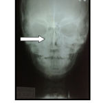 Figure 4: Pa View-Skull- shows deviated Nasal Septum