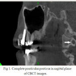 Figure 1: Complete ponticulus posticus in sagittal plane of CBCT images.