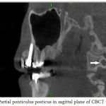 Figure 2: Partial ponticulus posticus in sagittal plane of CBCT images