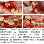 Figure 1: Clinical procedures of alveolar ridge preservation: A, atraumatic extraction of mandibular first premolar; B, filling the extraction socket with PDFDBA powder; C, covering the extraction socket with a collagen membrane; D, final suturing.