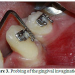Figure 3: Probing of the gingival invagination