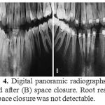 Figure 4: Digital panoramic radiographs before (A) and after (B) space closure. Root resorption after space closure was not detectable.