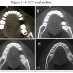 Figure 1: Cbct Axial Section