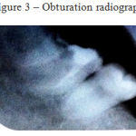 Figure 3: Obturation Radiograph