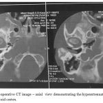 Figure 1: Pre-operative CT image – axial view demonstrating the hyperattenuating lesion on the right mastoid cortex.