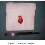 Figure 2: The tumour resected