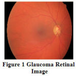 Figure 1: Glaucoma Retinal Image