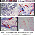 Figure 1: Microphotograph staining of trophoblastic placental tissues from miscarriage patients (red arrow): A- EBV IHC staining in cell nucleus intensity. B- IHC staining for CMV at cell nucleus. C- Negative IHC staining for EBV. D- EBV-ERER CISH positive signals in the cell nucleus of trophoblastic placental tissues showed score 2 and moderate intensity. E-CMV -DNA staining CISH of trophoblastic placental tissues in the cell nucleus score 1 and weak intensity. F- Negative CISH staining for EBV.