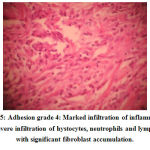 Figure 5: Adhesion grade 4: Marked infiltration of inflammatory cells, , severe infiltration of hystocytes, neutrophils and lymphocytes with significant fibroblast accumulation.