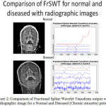 Figure 2: Comparison of Fractional Spline Wavelet Transform output with radiographic image for a Normal and Diseased (Chronic sinusitis) patient