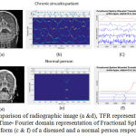 Figure 3: Comparison of radiographic image (a &d), TFR representation of EWT (b &e) and Time- Fourier domain representation of Fractional Spline Wavelet Transform (c & f) of a diseased and a normal person respectively