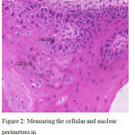 Figure 2: Measuring the cellular and nuclear perimeters in micrmeter in a severe dysplasia slide. H and E, 40x