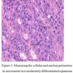 Figure 3: Measuring the cellular and nuclear perimeters in micrometer in a moderately differentiated squamous cell carcinoma. H and E, 40x