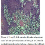 Figure 4: H and E slide showing high keratinization, mild nuclear pleomorphism, invading in the form of solid strings and moderate lympoplasmocytic infiltrate at ITF. H and E, 20x(Bryne’s total score=6)
