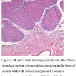 Figure 6: H and E slide showing moderate keratinization, abundant nuclear pleomorphism, invading in the form of islands with well defined margins and moderate lympoplasmocytic infiltrate at ITF. H and E, 20x (Bryne’s total score=8)