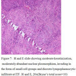 Figure 7: H and E slide showing moderate keratinization, moderately abundant nuclear pleomorphism, invading in the form of small cell groups and discrete lympoplasmocytic infiltrate at ITF. H and E, 20x(Bryne’s total score=10)