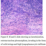 Figure 8: H and E slide showing no keratinization, extreme nuclear pleomorphism, invading in the form of solid strings and high lympoplasmocytic infiltrate at ITF. (photomicrograph showing ITF with Bryne’s total score=11) H and E, 20x.