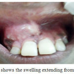 Figure 1: shows the swelling extending from 11 to 13.