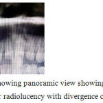 Figure 3: showing panoramic view showing a unilocular radiolucency with divergence of 12 and 13.