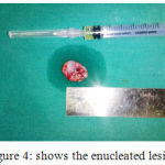 Figure 4: shows the enucleated lesion.