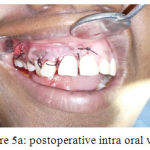 Figure 5a: postoperative intra oral view