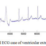 Figure 3: Artificial ECG case of ventricular extrasystole