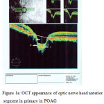 Figure 1a: OCT appearance of optic nerve head anterior segment in primary in POAG No.1 arrow shows ONHD, No.2 arrow shows PLCD and No.3 arrow shows LCT