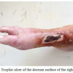 Figure 1: Trophic ulcer of the dorsum surface of the right foot.