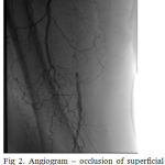 Figure 3: Angiogram – popliteal-pedidial segment.