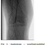 Figure 3: Angiogram – occlusion of superficial femoral artery.