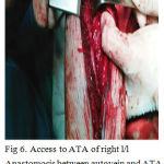 Figure 6: Access to ATA of right l/l Anastomosis between autovein and ATA was applied with the formation of AV-fistula between ATA and ATV.