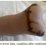 Figure 7: Right lower limb, condition after combined treatment.