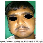 Figure 1: Diffuse swelling on the bilateral cheek region