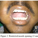 Figure 2: Restricted mouth opening-13 mm