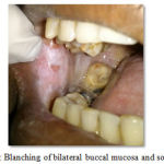 Figure 3: Blanching of bilateral buccal mucosa and soft palate